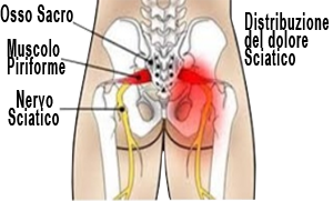 Sciatica