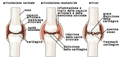 Osteoartrosi