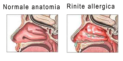 Rinite allergica