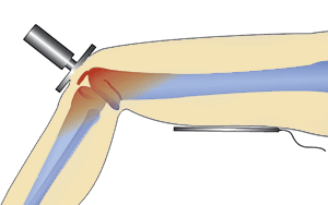 Metodi di applicazione della tecarterapia